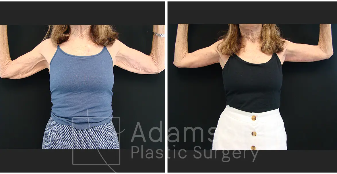 Brachioplasty - AMM