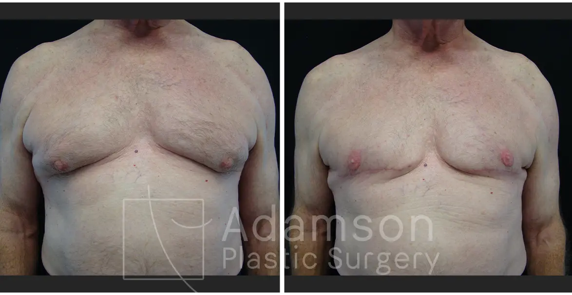 Gynecomastia - CS