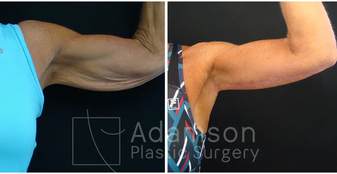 Brachioplasty - DD