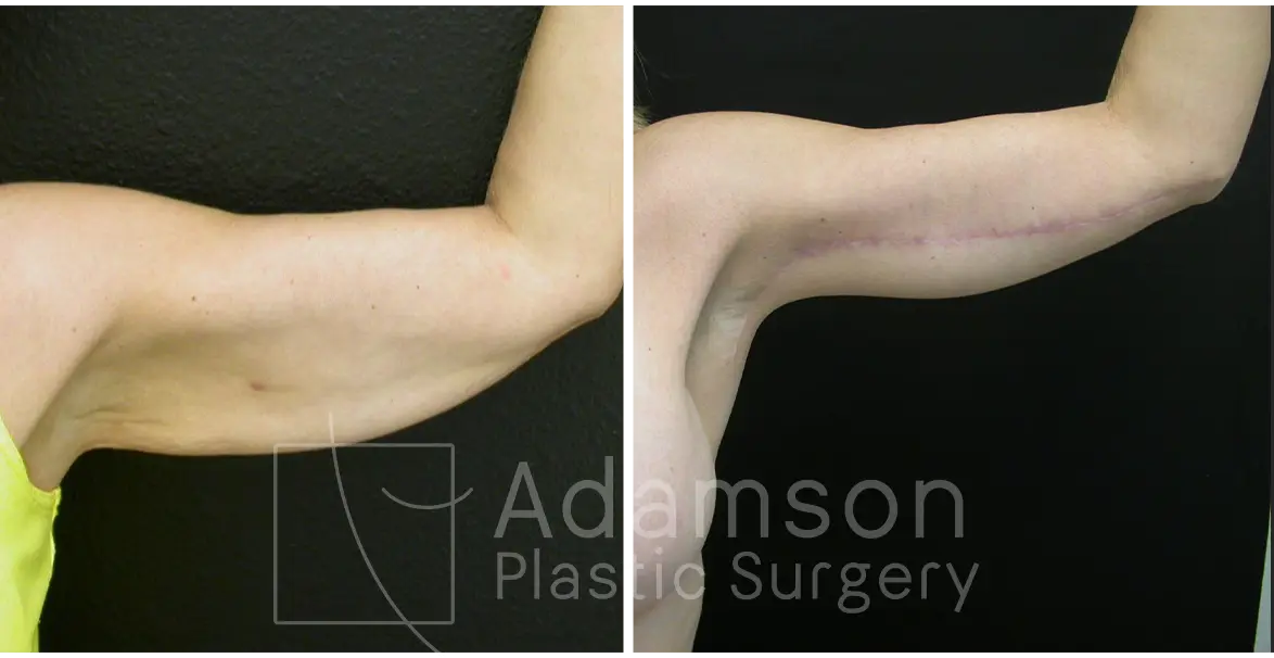 Brachioplasty - KK