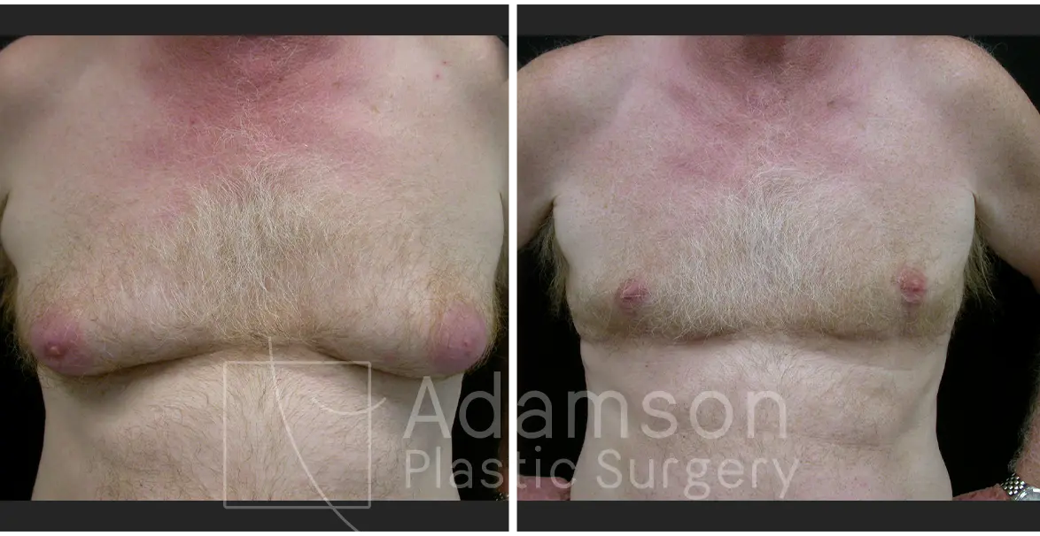 Gynecomastia - LM