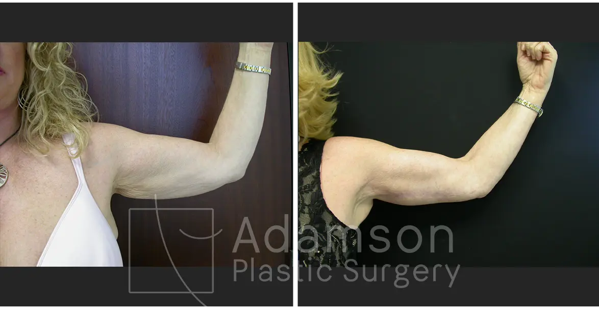 Brachioplasty - MD