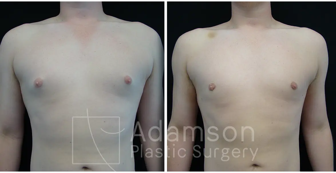 Gynecomastia - MS