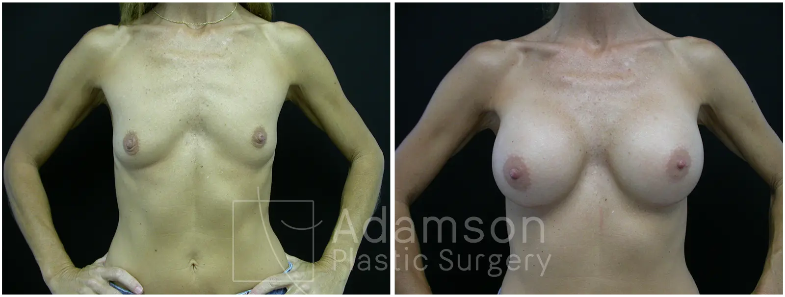 Breast Augmentation Case LR