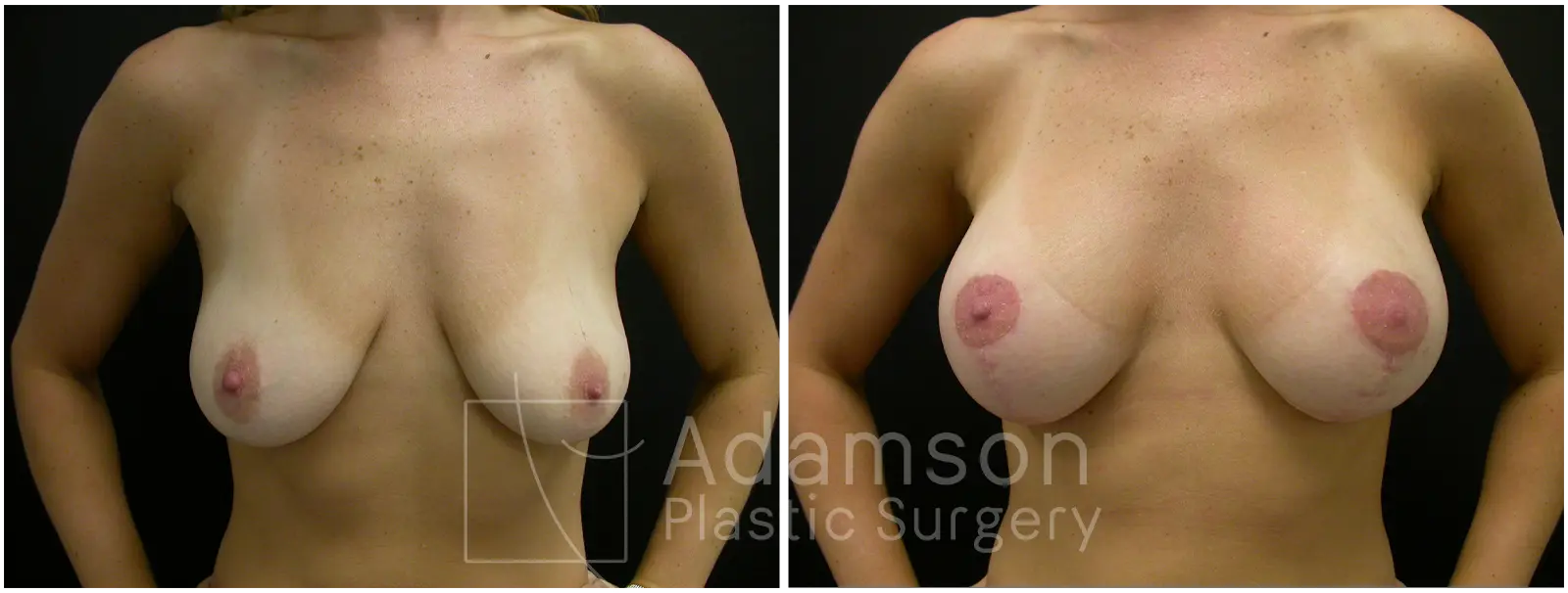 Breast Augmentation Case WC