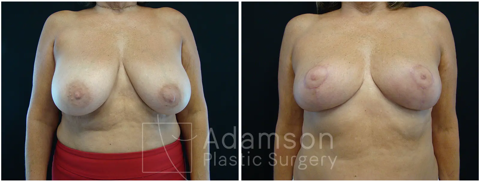 Breast Lift Reduction SSC