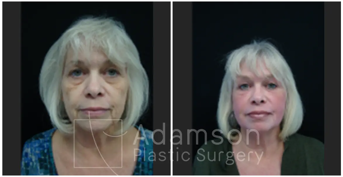 Treatment of The Skin AA