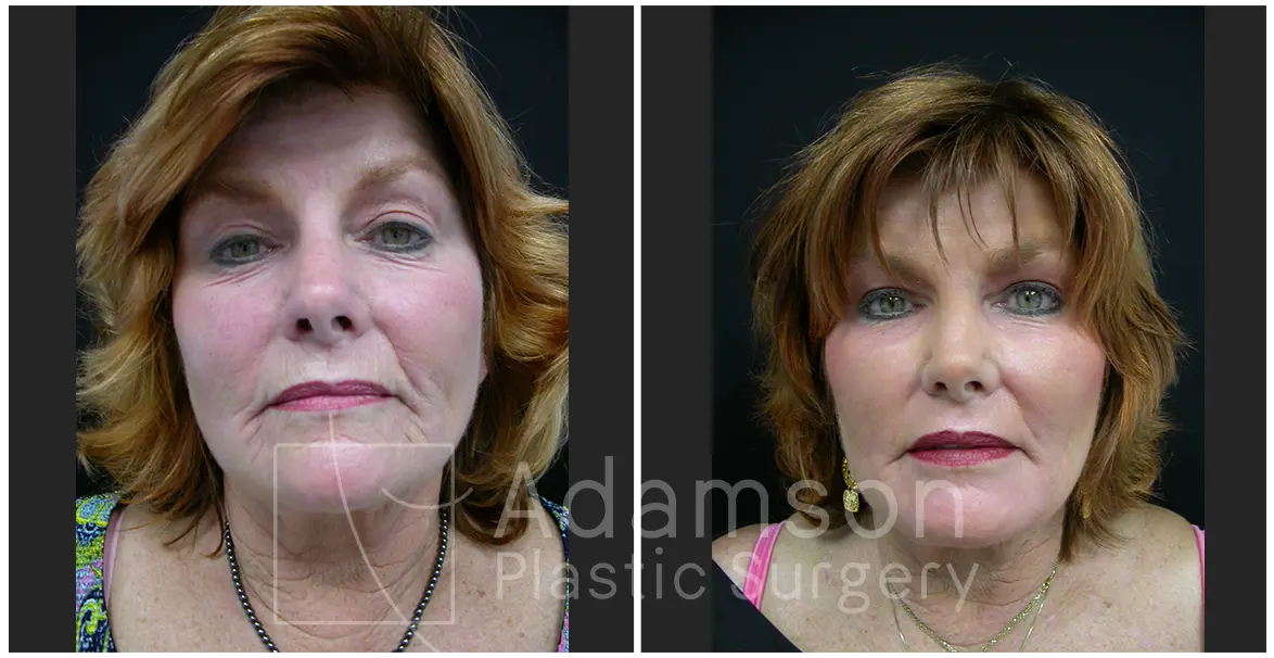 Treatment of The Skin AR