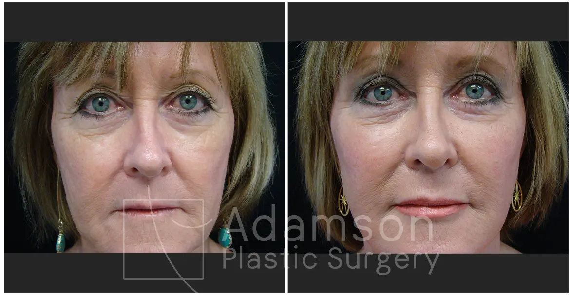 Facelifts CD