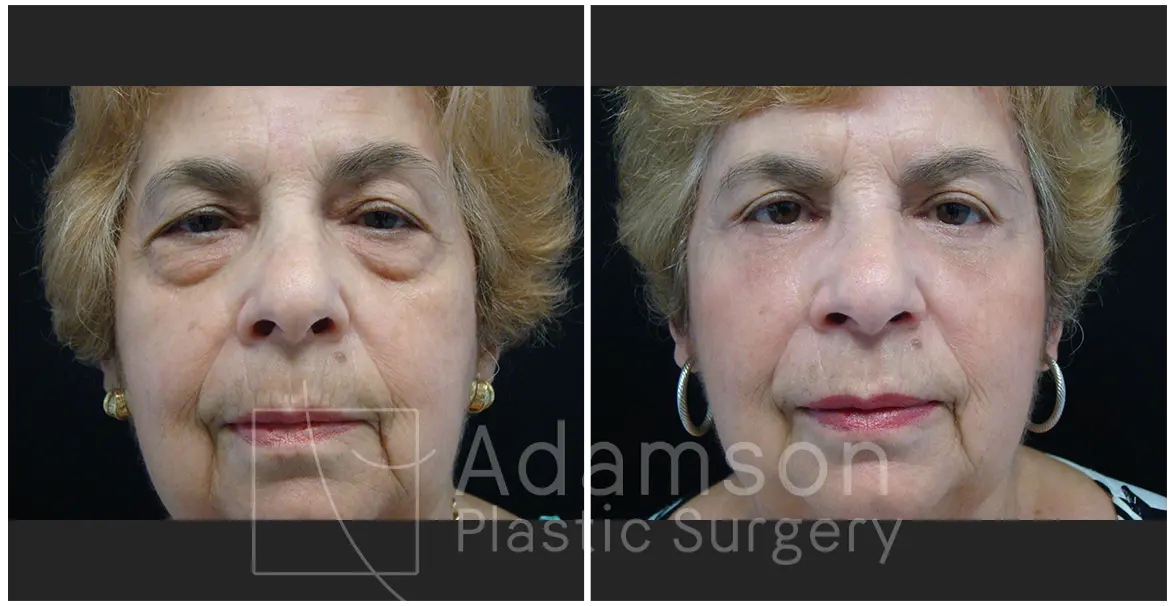 Surgery of The Eyelids GF