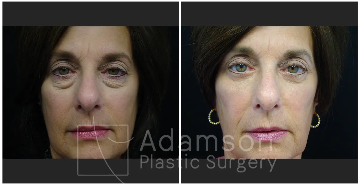 Surgery of The Eyelids JD