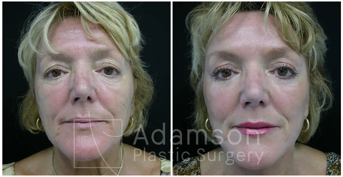 Facelifts KC