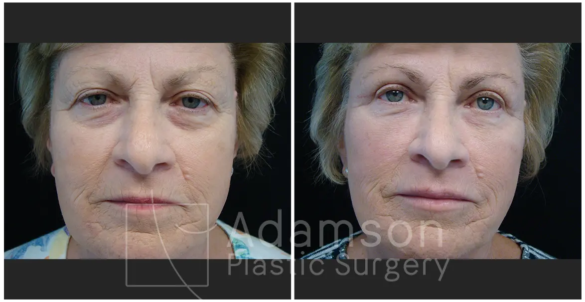 Surgery of The Eyelids KN
