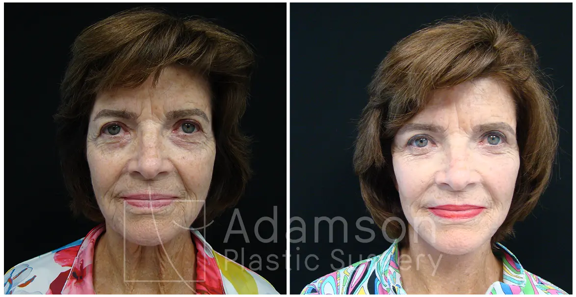 Facelifts LK