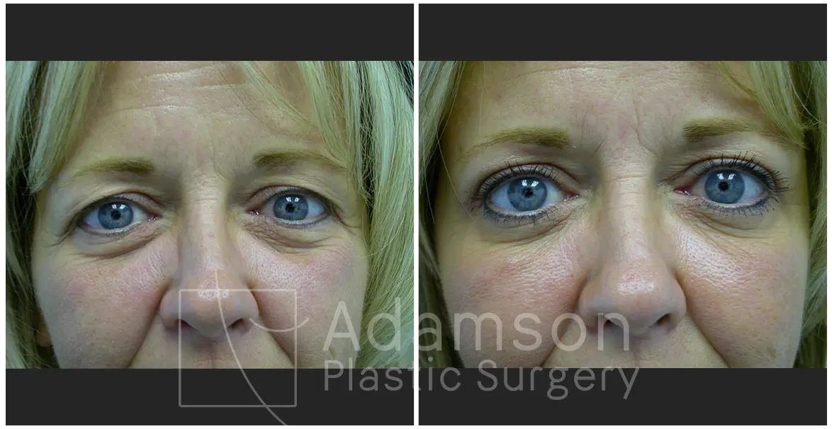 Surgery of The Eyelids LK