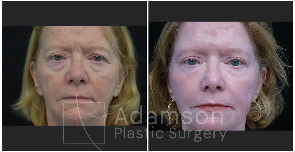 Treatment of The Skin MR