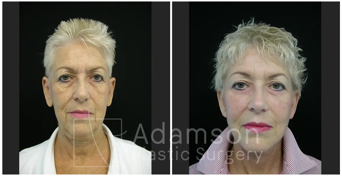 Facelifts RR