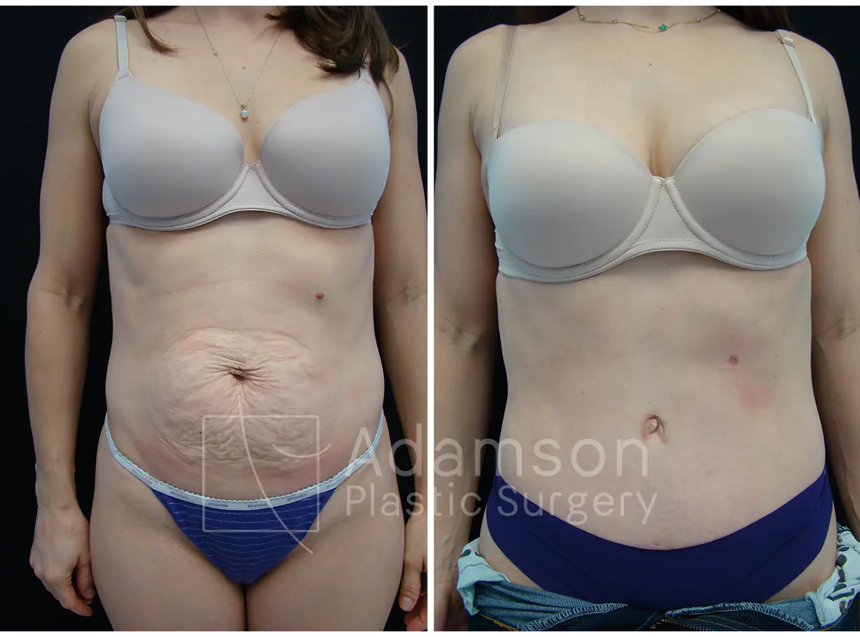 Abdominoplasty - AH