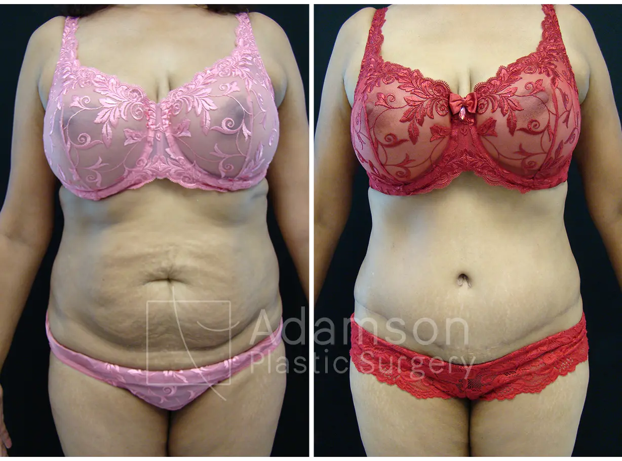 Abdominoplasty - AM