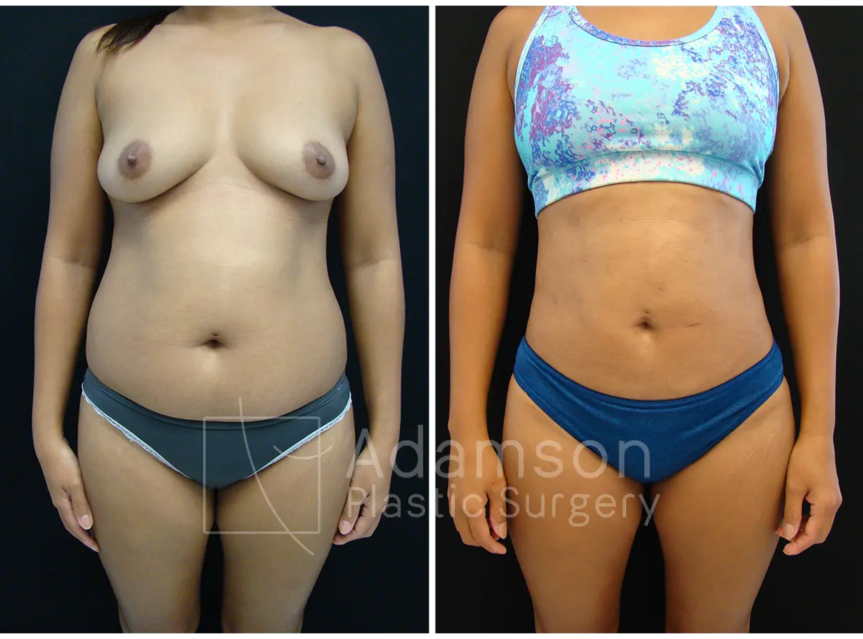 Liposuction - AP