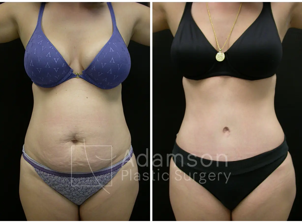 Abdominoplasty - CY