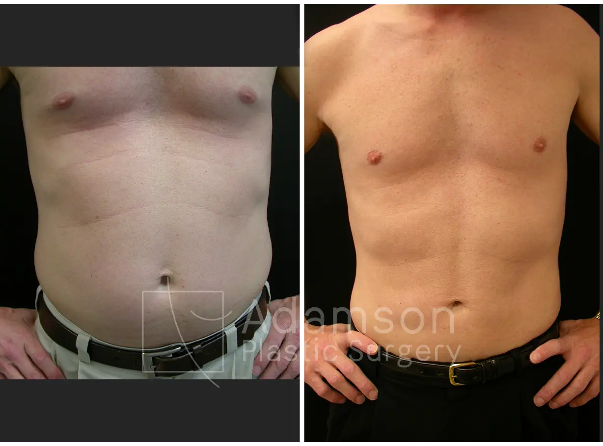 Liposuction - DY