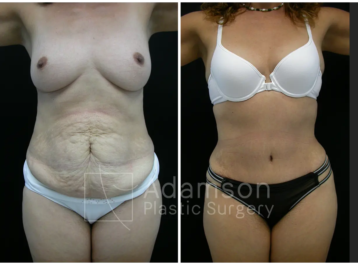 Abdominoplasty - IC
