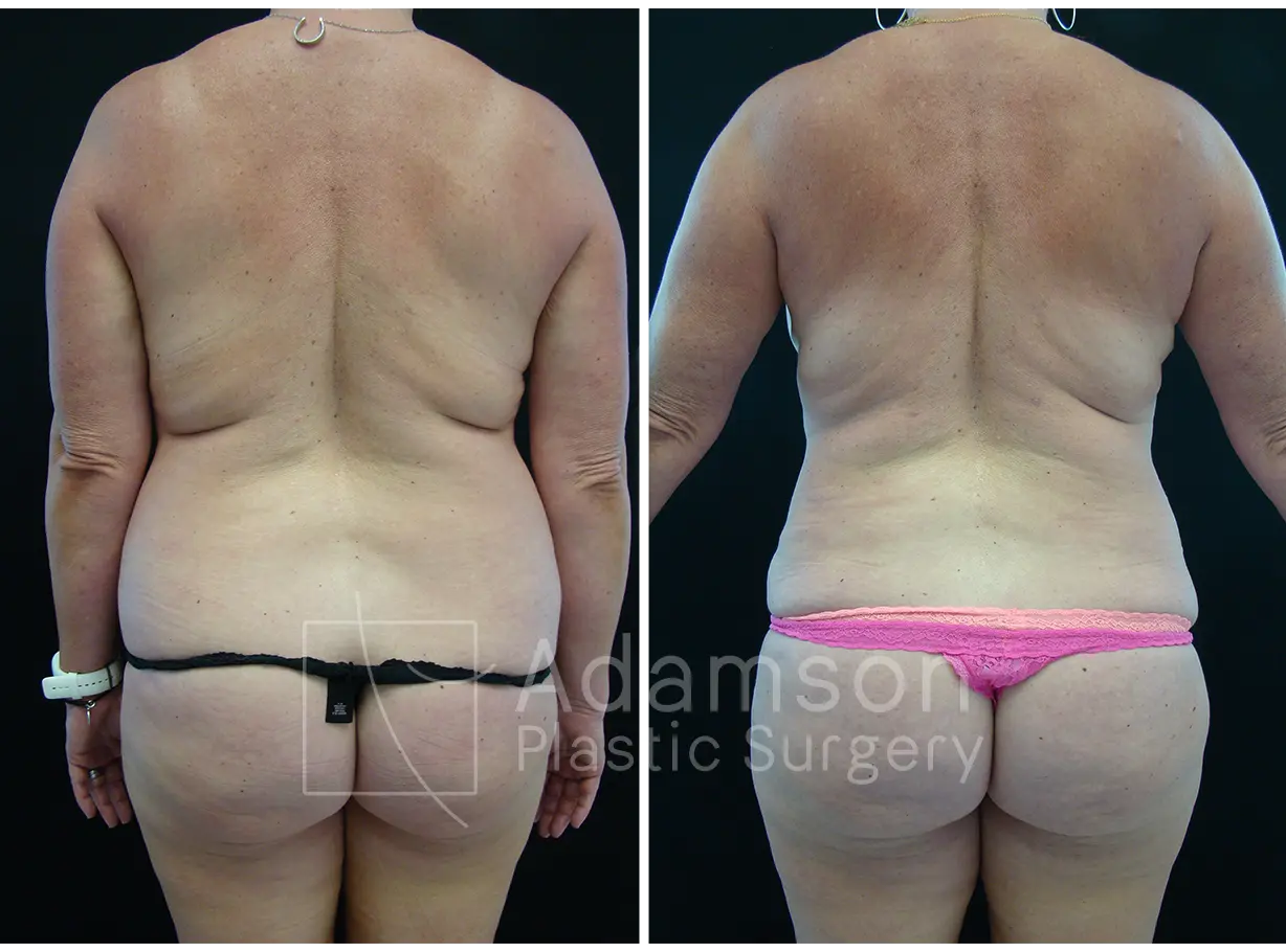 Liposuction - KM