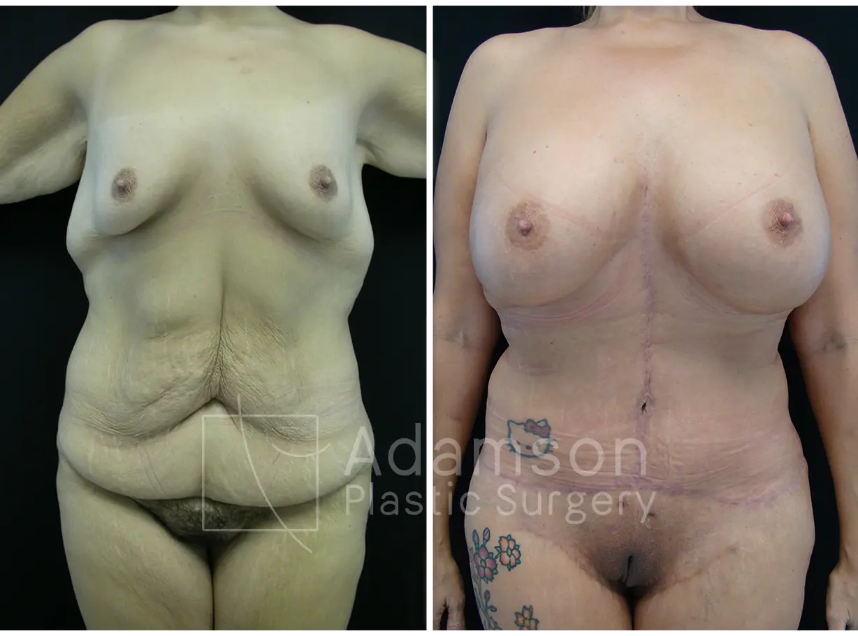 Massive Weight Loss - MS