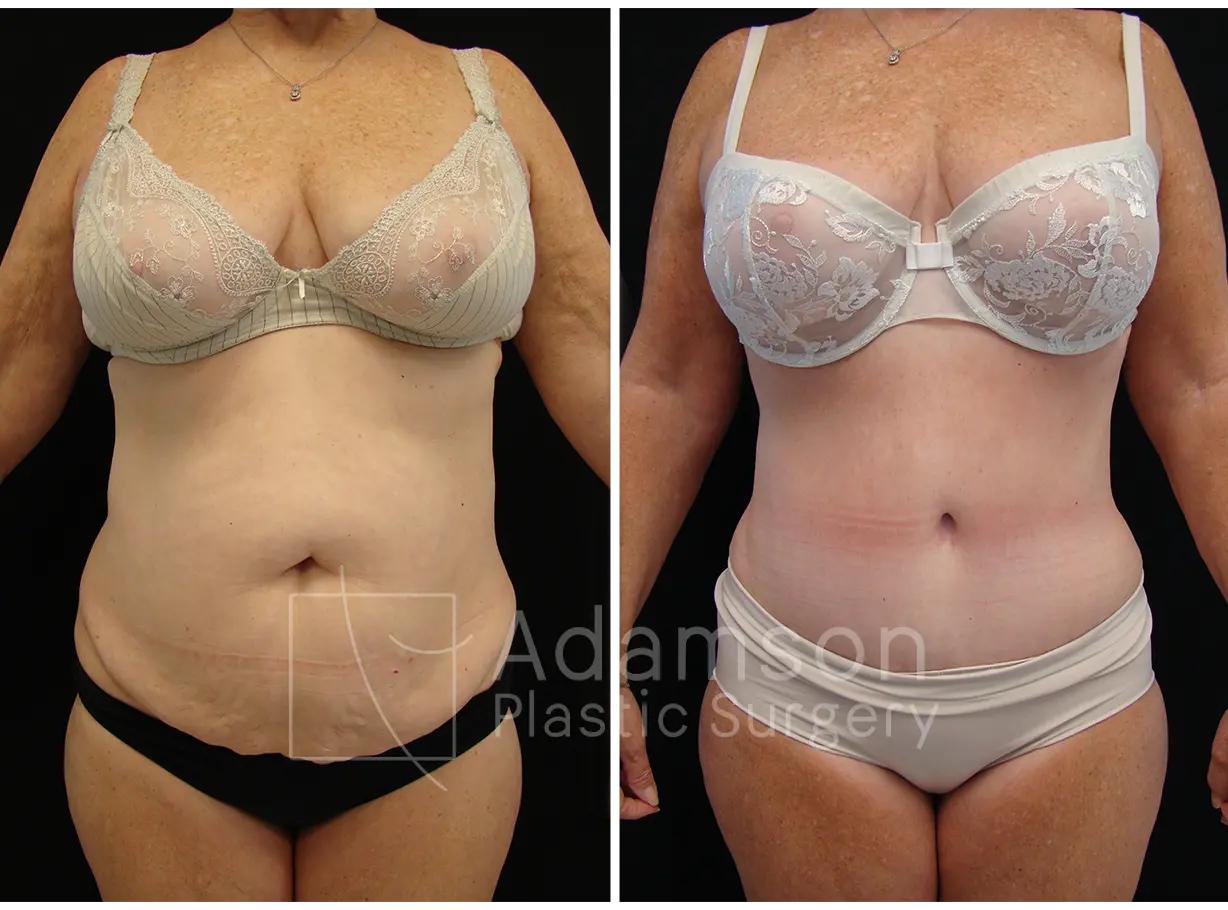 Abdominoplasty - MW