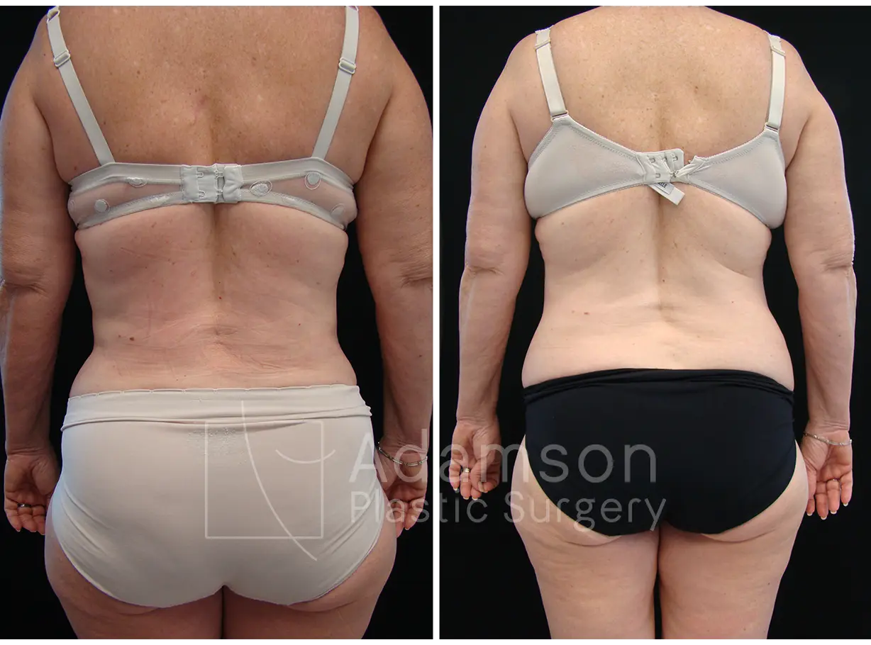 Liposuction - MW