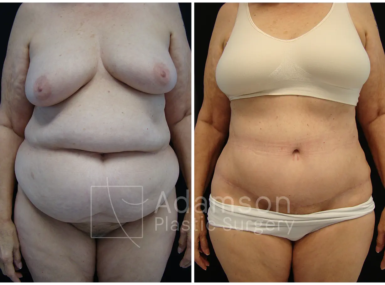 Abdominoplasty - SK