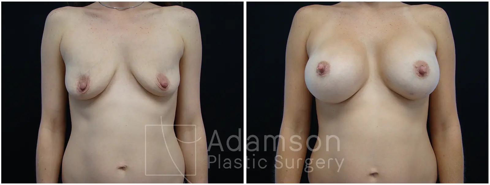 Breast Augmentation Case RB