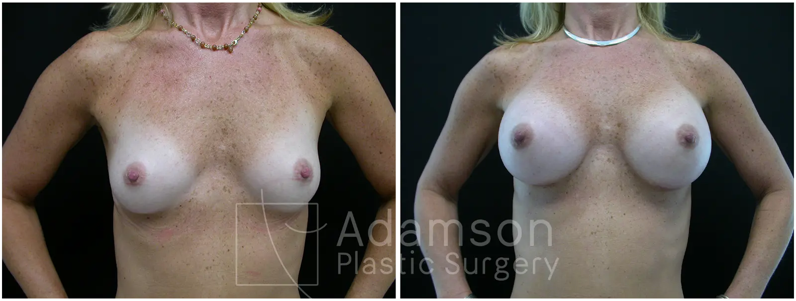 Breast Augmentation Case SK