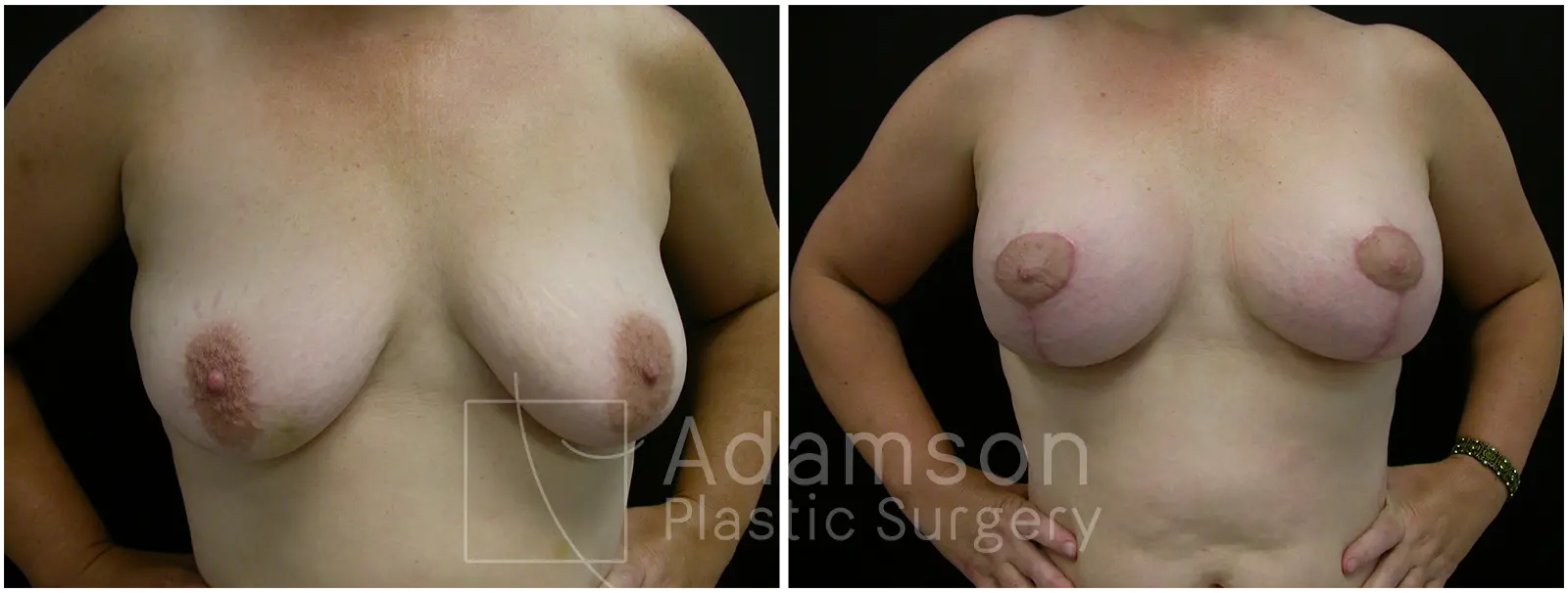 Breast Augmentation Case SVC