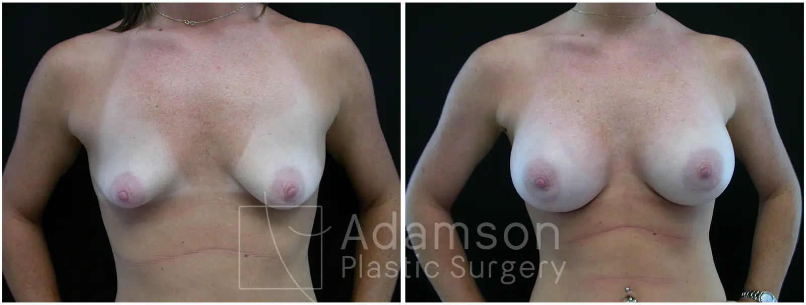 Breast Augmentation Case TY