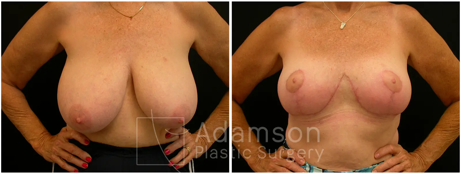 Breast Lift Reduction GS