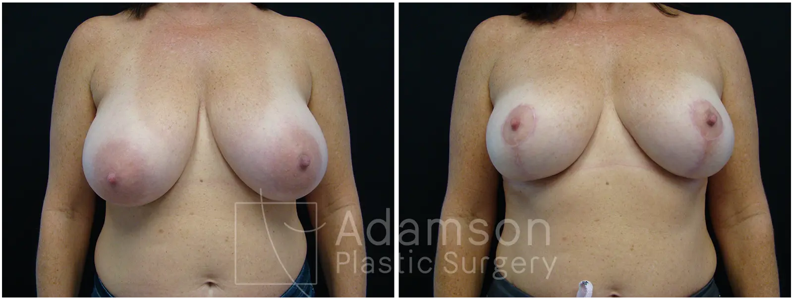 Breast Lift Reduction JI