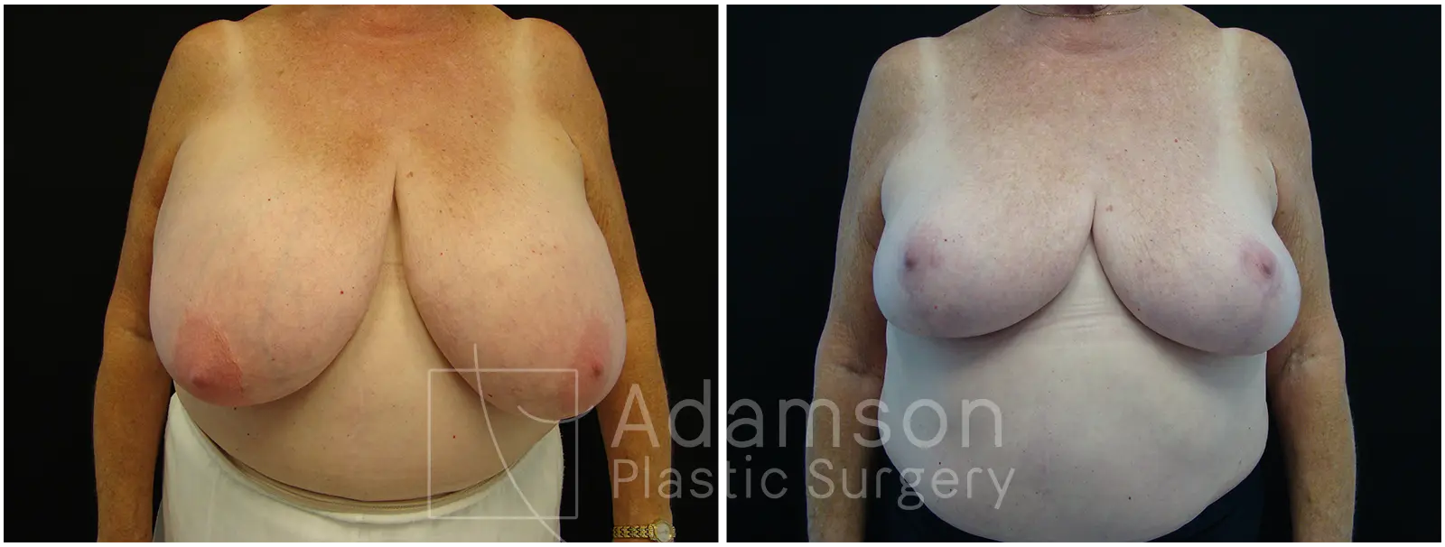 Breast Lift Reduction JP