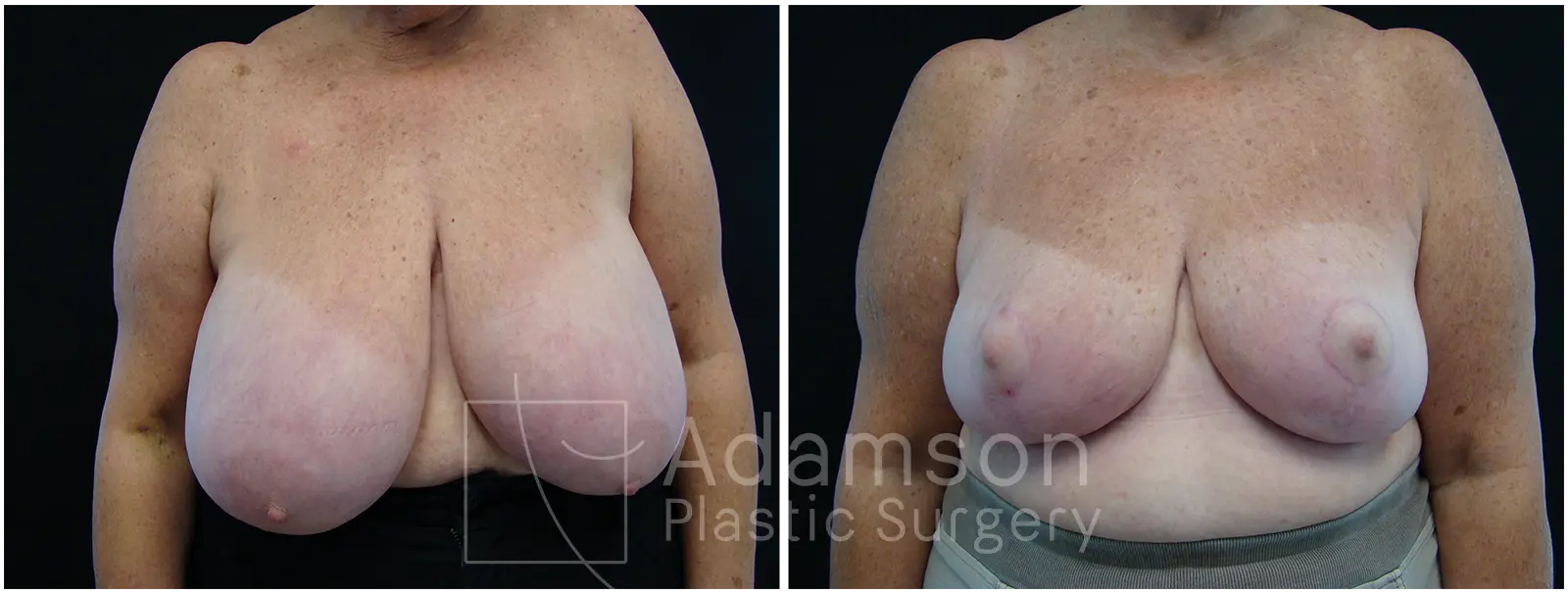 Breast Lift Reduction PC