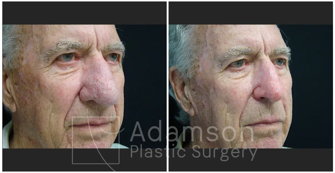 Surgery of The Nose AL