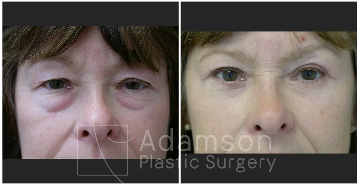 Surgery of The Eyelids DR