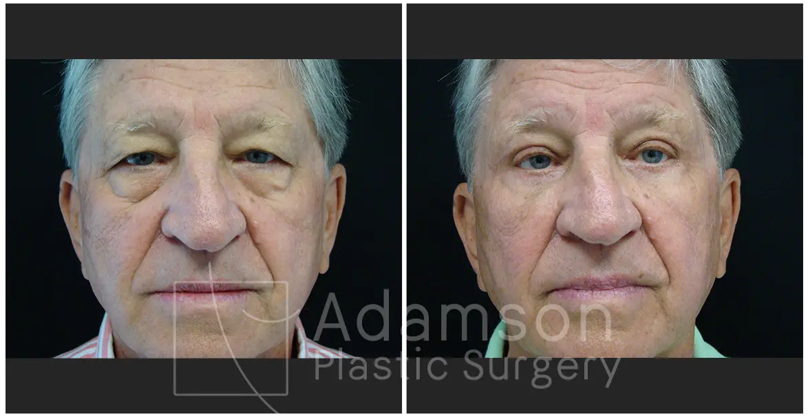 Surgery of The Eyelids DS