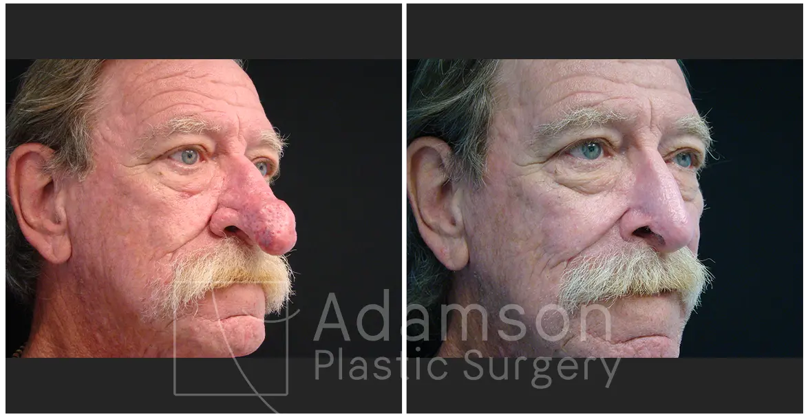 Surgery of The Nose GC