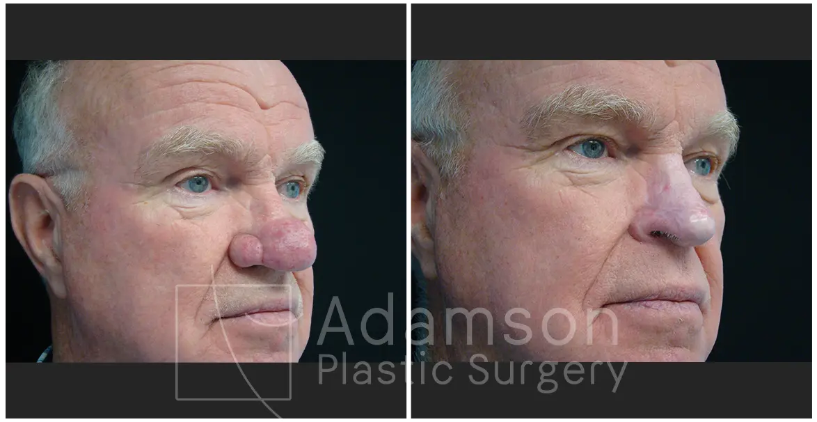 Surgery of The Nose TS